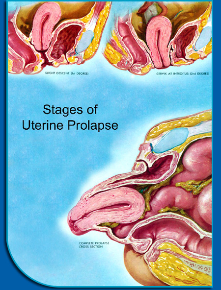 A case of myiasis in stage IV pelvic organ prolapse